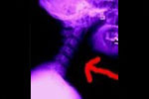 Throat